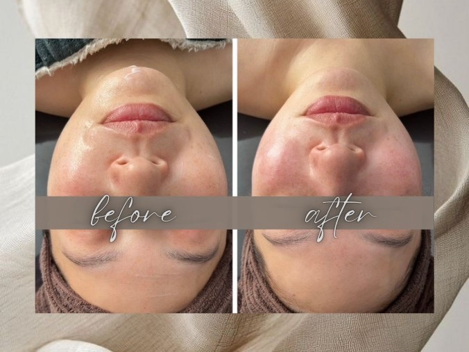 Before After 01
