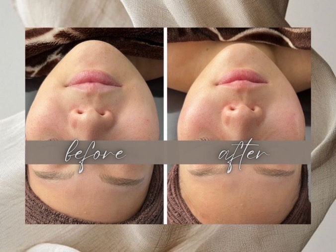 Before After 02