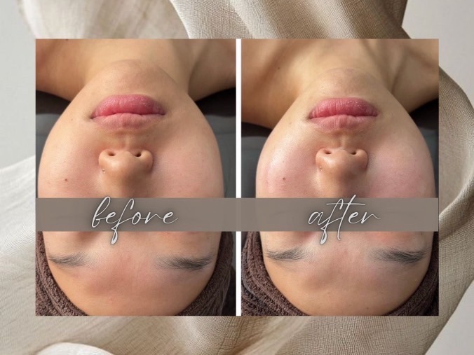 Before After 04
